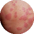 Urticaria listing
