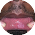 Syphilis listing