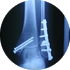 Biodegradable implant bones