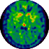 Cancer medicine to fight parkinson